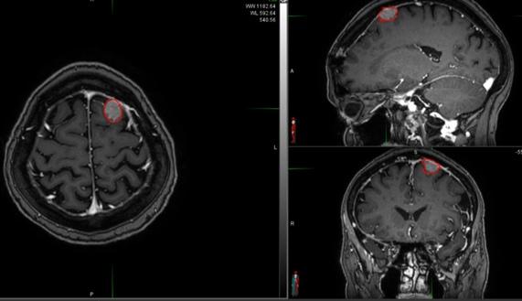 Метастазы в мозг прогноз. Метастазы головного мозга кт. Метастазы меланомы в головной мозг мрт. Метастаз в головном мозге кт мрт. Метастазы меланомы в головной мозг кт.