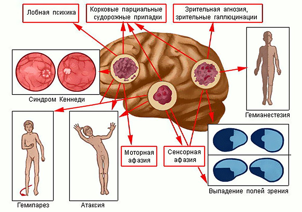 Опухоль головного мозга у взрослых